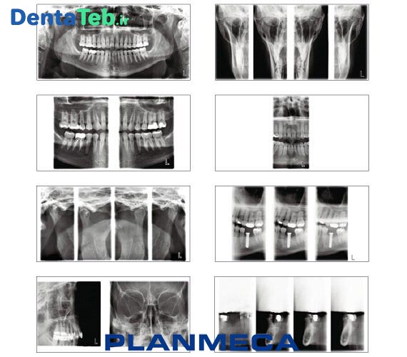 رادیوگرافی دندانپزشکی Planmeca