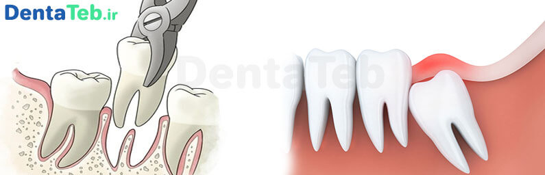چگونگی کشیدن دندان