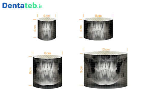 تصاویر 3بعدی رادیوگرافی opg واتک | رادیوگرافی opg واتک