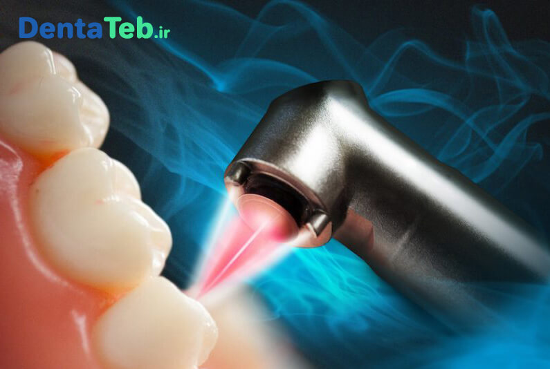 لیزر دندانپزشکی | کاربرد لیزر در دندانپزشکی