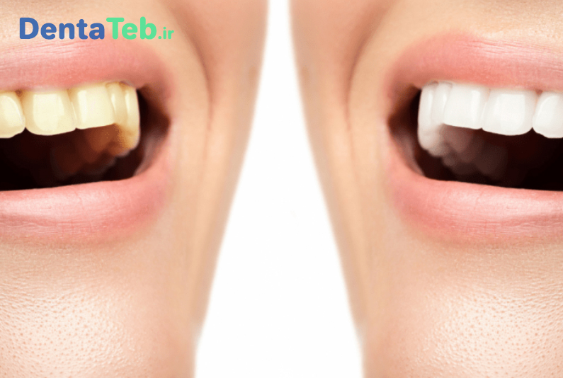 هوم بلیچینگ دندان | بلیچینگ دندان چیست