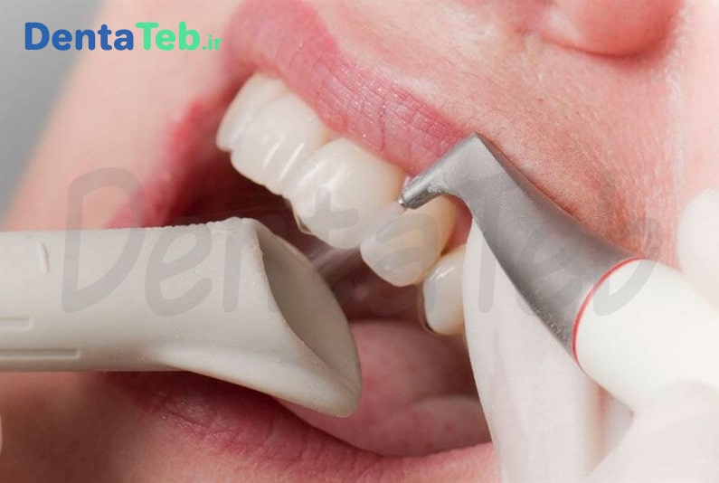 نحوه کار با ایرفلو دندانپزشکی | ایرفلو دندانپزشکی چیست